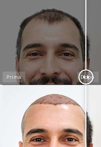 trapianto capelli prima e dopo